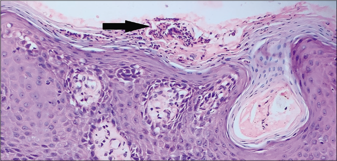 Magnified view showing collection of neutrophils within the parakeratotic layer that is Munro’s microabscess (H & E, ×400)