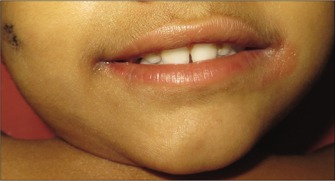 At age 1 year and 4 months, mild erythema with fine scaling at the angles of the mouth