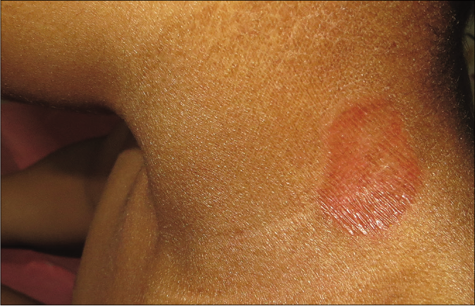 Fine scaling along with well-defined areas of erythema over the neck