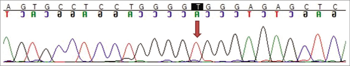 Sequence chromatogram showing homozygous missense variation in exon 12 of the ALOX12B gene (chr17:g.7978925G>A; c.1642C>T; p. Arg548Trp) in the proband (indicated by red arrow)