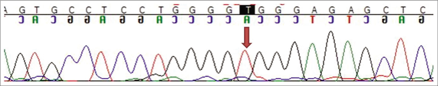 Sequence chromatogram showing identical mutation as the proband in homozygous state in the father (indicated by red arrow)