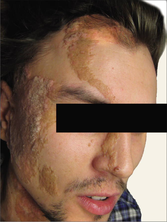 Epidermal nevus in blaschkoid distribution over the face in a male patient before copper vapor laser treatment