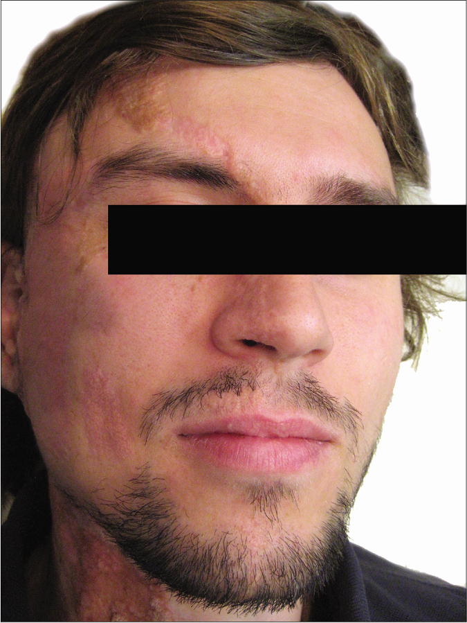 epidermal nevus face