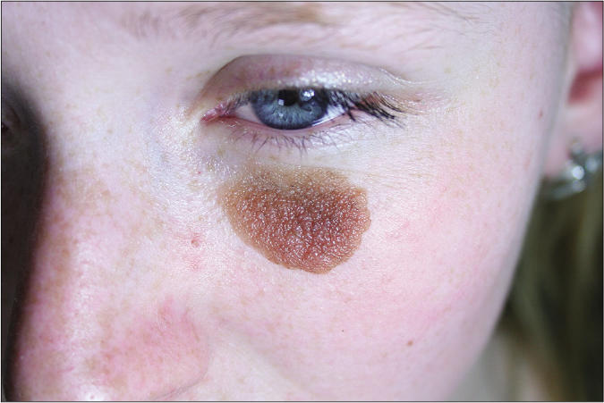 Congenital Nevus Face