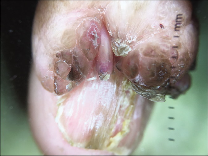 Multiple, erythematous to hyperpigmented, polypoidal and digitate growths. Garlic clove morphology with a yellow-brown scale at the tip of the central growth, and longitudinal striations on nail (Dermoscopy using Dermlite DL200 Hybrid, ×10)