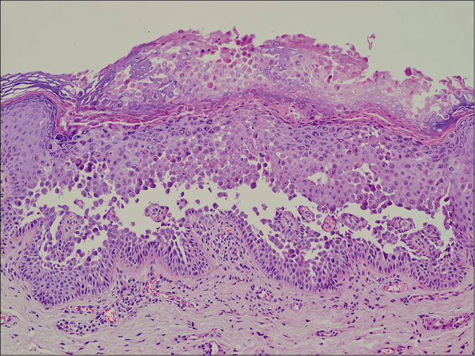 Acantholysis throughout the epidermis, hyperkeratosis, and parakeratosis were found in the epidermis with chronic inflammation in the underlying dermis (H and E, ×100)