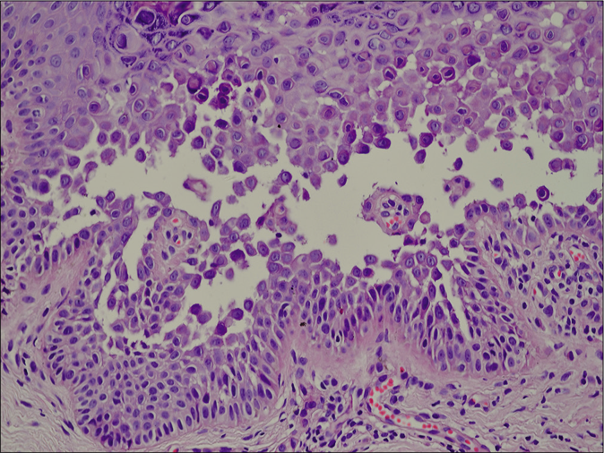 Acantholysis and dyskeratosis with the presence of corps ronds and grains (H and E, ×400)