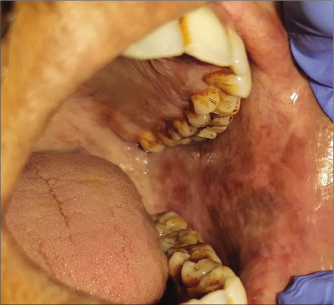 Blanching of oral mucosa with melanotic pigmentation