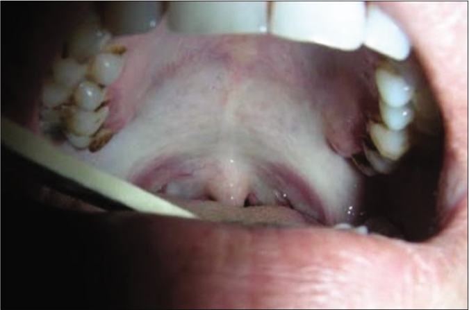 Shrunken uvula with blanching of palatal mucosa