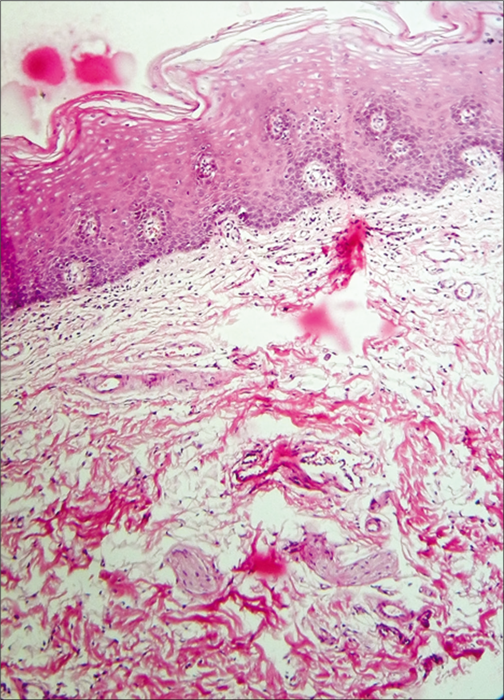 Histopathology of oral submucous fibrosis (H and E, ×400)— Parakeratinized stratified squamous oral epithelium with the absence of rete ridges. Thickening of the spinous layer with dysplastic features like hyperchromatism, increased nuclear to cytoplasmic ratio in the basal region. Interlacing bundles of dense hyalinized collagen fibers, inflammatory infiltrate predominantly lymphocytes and fibrosed blood vessels in the connective tissue. Deeper connective shows the presence of the T.S section of the muscle fibers.