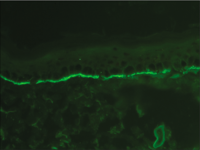 Direct immunofluorescence microscopy of perilesional skin from a patient with bullous pemphigoid showing linear deposition of C3 along the basement membrane zone (fluorescein isothiocyanate, ×400)