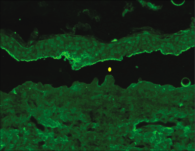 Indirect immunofluorescence using salt split skin substrate showing linear IgG deposition on the epidermal side of the split in a patient with bullous pemphigoid (yellow circle indicating the level of split) (fluorescein isothiocyanate, ×200)