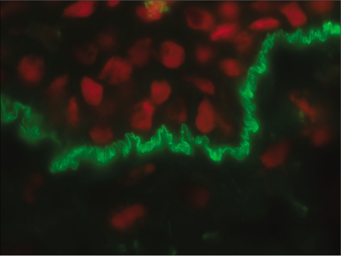 Direct immunofluorescence microscopy of perilesional skin showing “n” serrated pattern in a patient with bullous pemphigoid (fluorescein isothiocyanate, ×1000 under oil immersion)