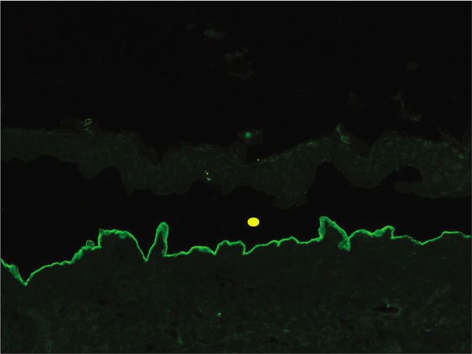 Indirect immunofluorescence using salt split skin substrate and serum of a patient with anti-p200 pemphigoid showing linear IgG deposition on the dermal side of the split (yellow circle indicating the level of split) (fluorescein isothiocyanate, ×200)