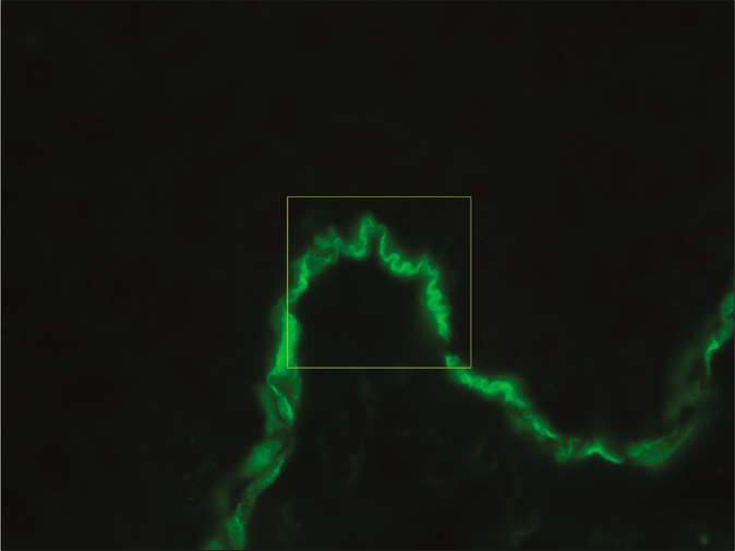 Direct immunofluorescence microscopy of perilesional skin showing “n” serrated pattern in a patient with anti-p200 pemphigoid (fluorescein isothiocyanate, ×1000 under oil immersion)