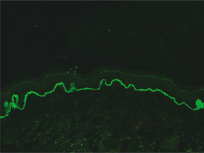 Indirect immunofluorescence microscopy using recessive dystrophic epidermolysis bullosa skin lacking Type VII collagen and serum of anti-p-200 pemphigoid showing linear staining of basement membrane zone (fluorescein isothiocyanate, ×200)