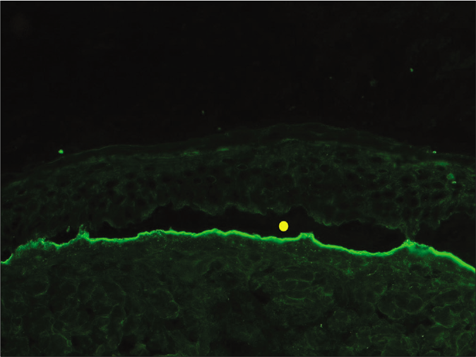 Indirect immunofluorescence using salt split skin substrate and serum of a patient with epidermolysis bullosa acquisita showing linear IgG deposition on the dermal side of the split (yellow circle indicating the level of split) (fluorescein isothiocyanate, ×200)