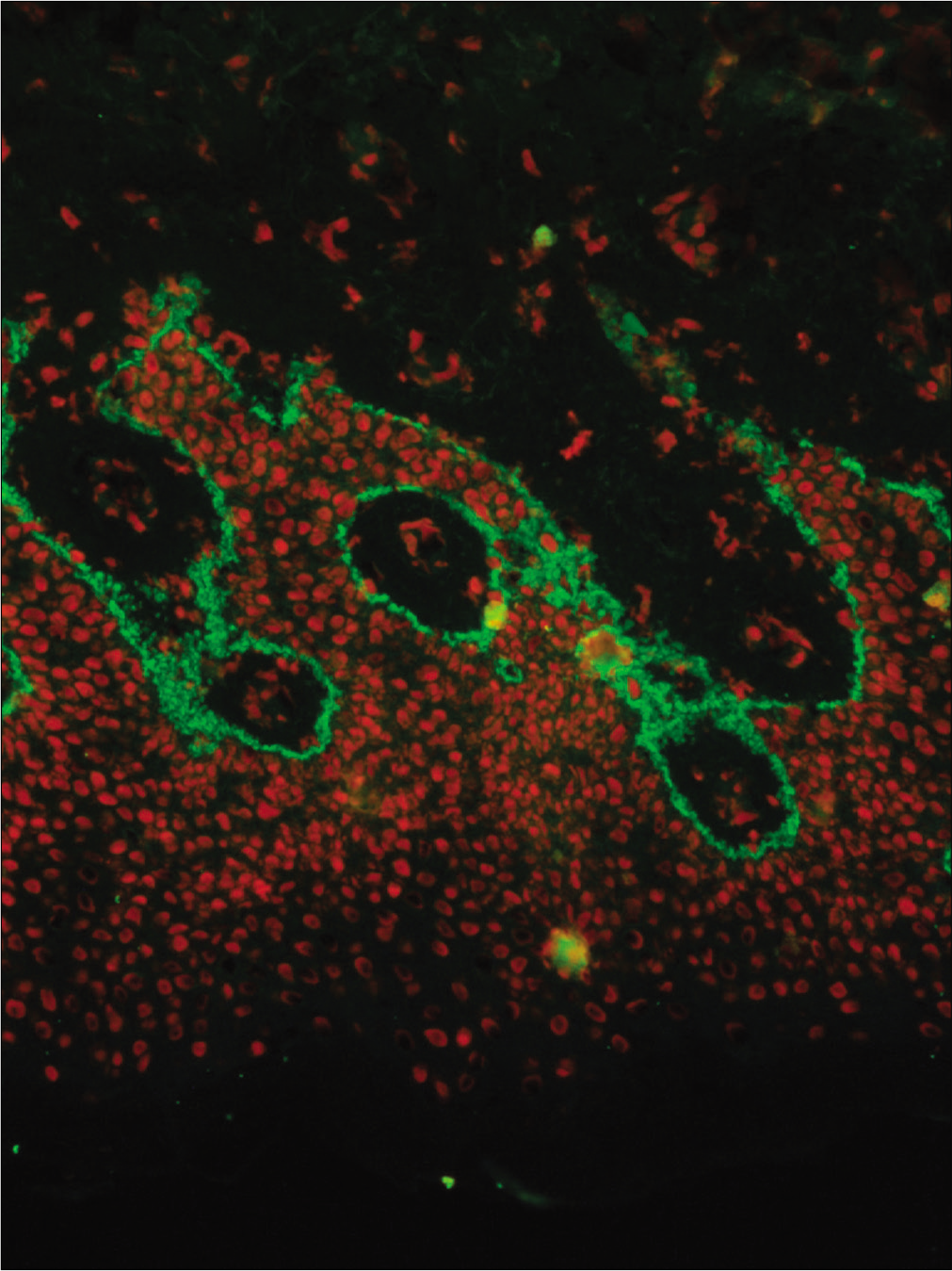 Direct immunofluorescence of a perilesional biopsy with strong linear staining of C3 at the dermal-epidermal junction in patient No 7 (fluorescein isothiocyanate, 400×)