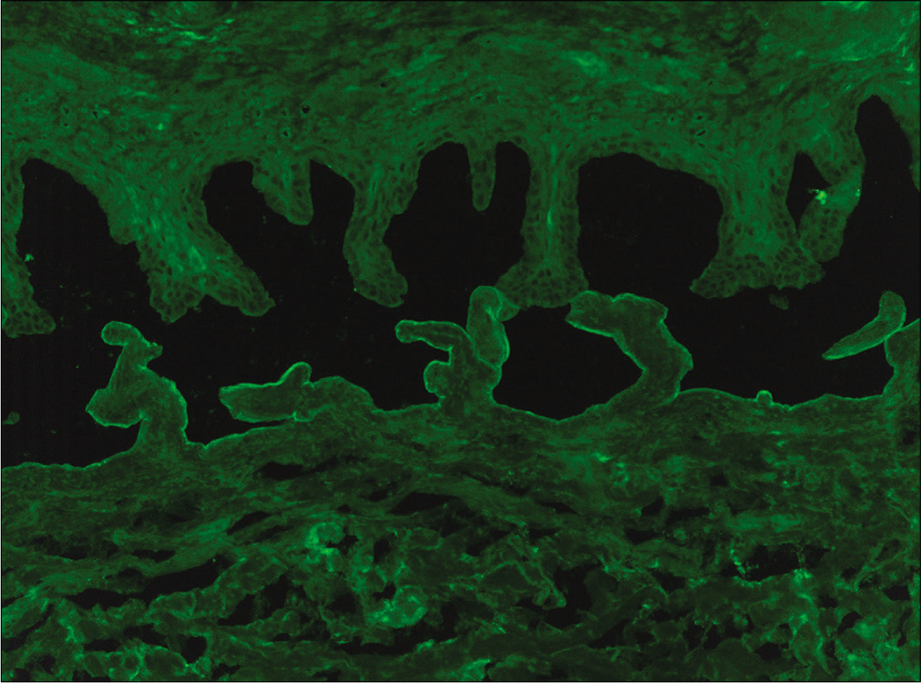 Binding of IgG along the floor of the artificial split by indirect immunofluorescence microscopy on salt-split skin in patient No 12 (fluorescein isothiocyanate, 200×)