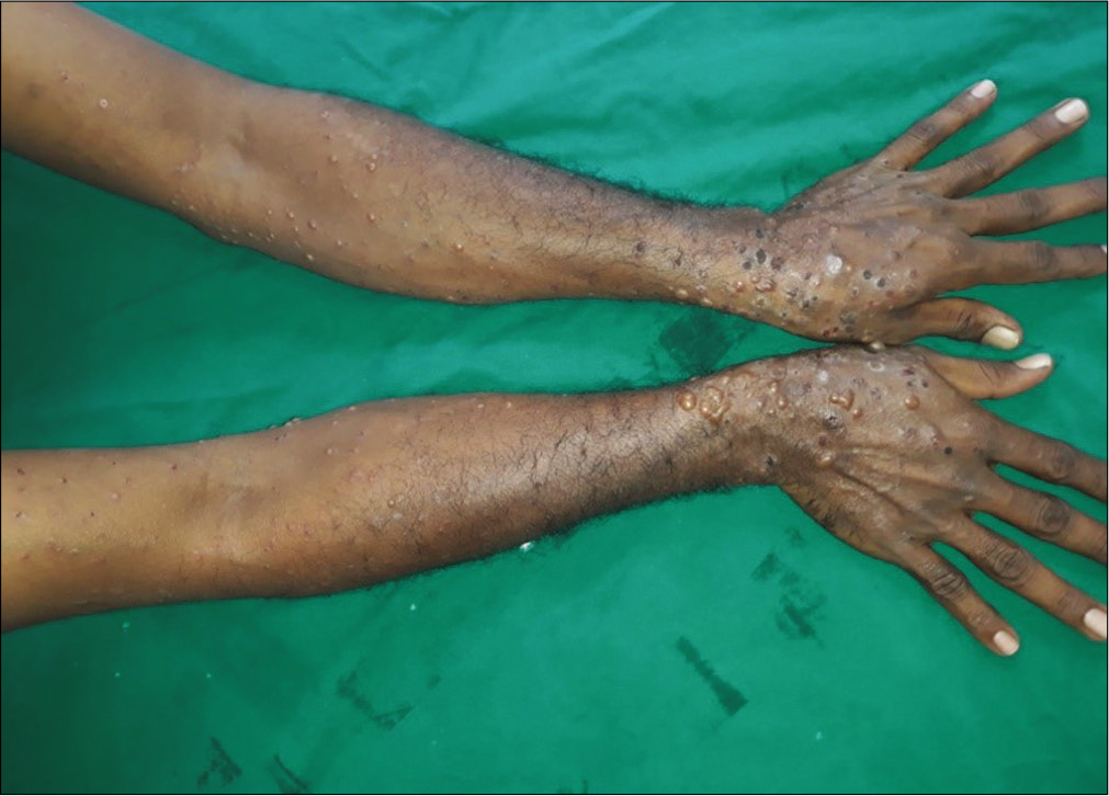 Numerous tense blisters and erosions on lower arms in patient No 12
