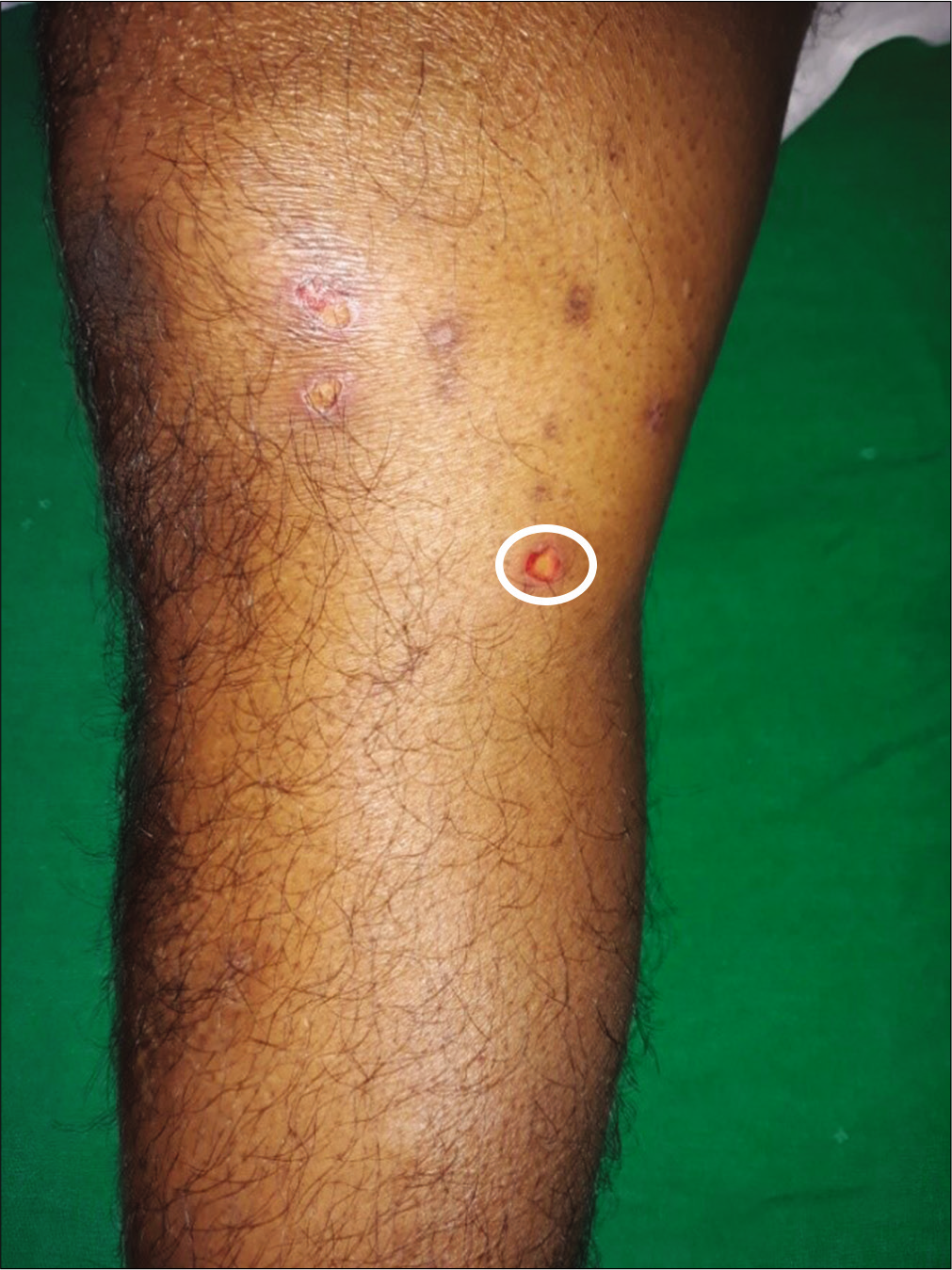 Erosions on right knee in patient No 20