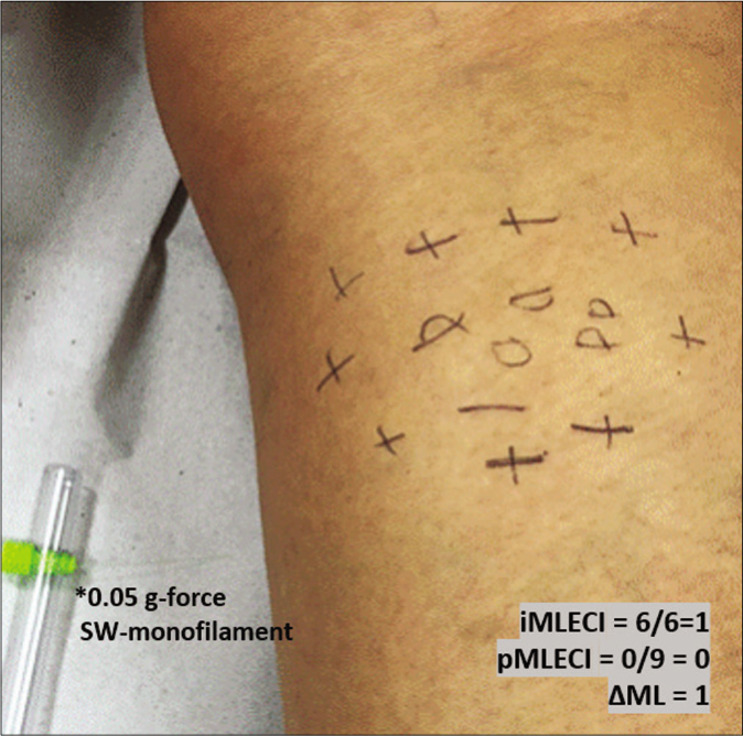 Mapping of touch sensation test with 0.05 g force Semmes-Weinstein (SW)-monofilament in the MLSG indicating normoesthesia (+); hypoesthesia (−) and anesthesia (0) areas