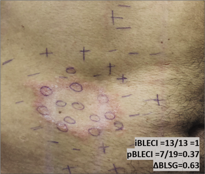 Mapping of touch sensation test with 0.05 g force SWmonofilament in BLSG indicating normoesthesia (+); hypoesthesia (−) and anesthesia (0) areas in Borderline Leprosy subgroup (BLSG) indicating altered sensation hypoesthesia (-) or anesthesia (0) within the lesion and predominately normoesthesia (+) in peripheral areas, to calculate the (i) internal and (p) peripheral esthesiometric change indexes (ECI), and the difference (Δ) between indexes in BL subgroup.