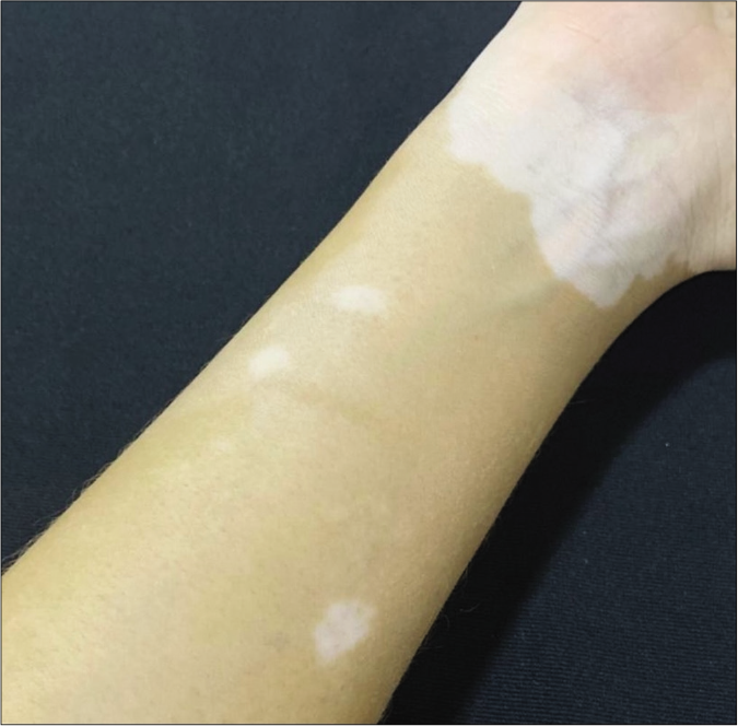 Typical achromatic macule of vitiligo in patient in the NLG