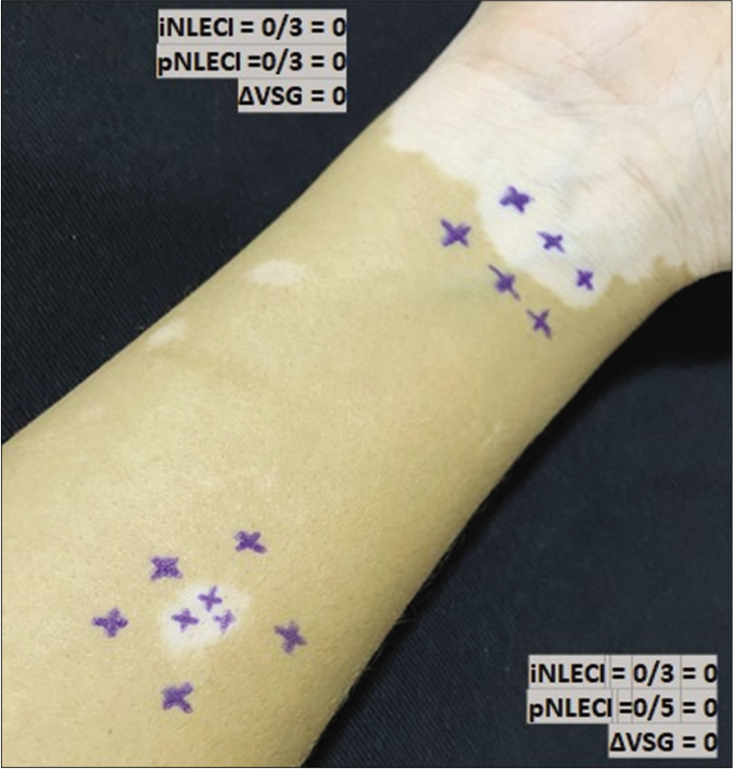 Mapping of normal touch sensation test with 0.05 g force SWmonofilament in vitiligo lesion in the non-leprosy (NL) group indicating points with normoesthesia (+) within the lesion and in peripheral areas to calculate (i) internal and (p) peripheral esthesiometric change indexes (ECI), and the difference (Δ) between indexes in Vitiligo Subgroup (VSG).