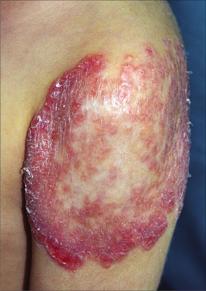 Erythematous large plaque showing central clearing with mild atrophy, erosions in the periphery (lower border) and few satellite nodules near the upper border