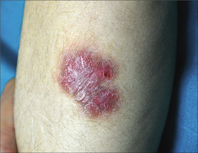 Erythematous plaque on the left leg