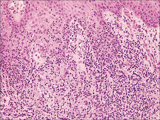 Histopathology of skin biopsy from left-arm showing nodular granulomatous infiltrate of epithelioid cells and multinucleated giant cells surrounded by dense lymphocytic infiltrate (H and E, ×100)