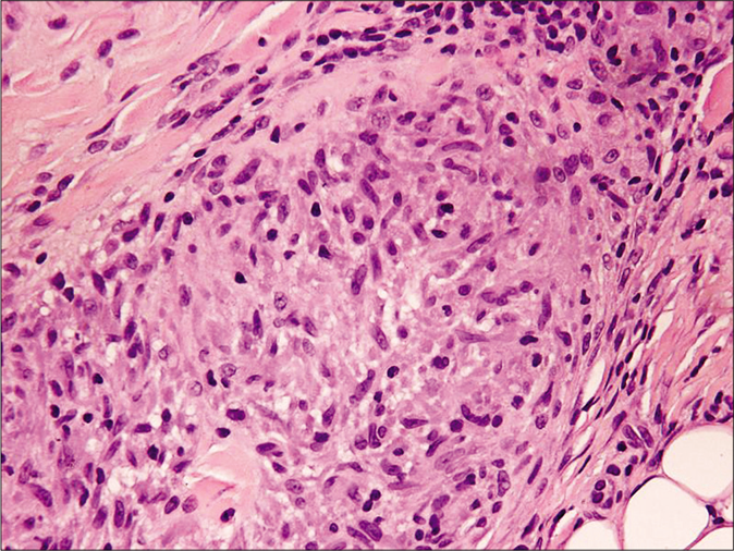 Histopathology of skin biopsy from left-arm showing well-formed epithelioid cell granuloma in the deep dermis (H and E, ×400)