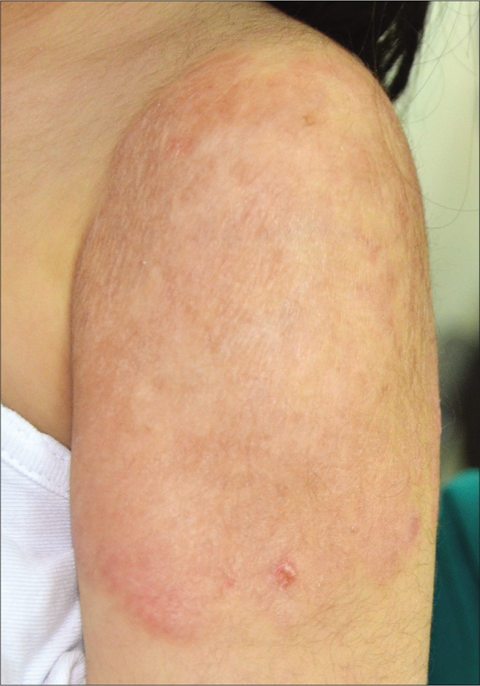 Lesion showing complete healing with some atrophy and dyspigmentation after 3 months of clarithromycin therapy