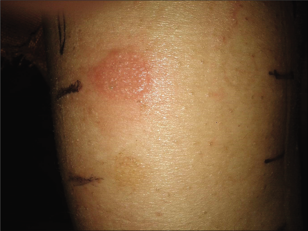 Preimplant positive (2+) reaction to nickel in a female patient who had history of itching and oozing while using artificial jewelry