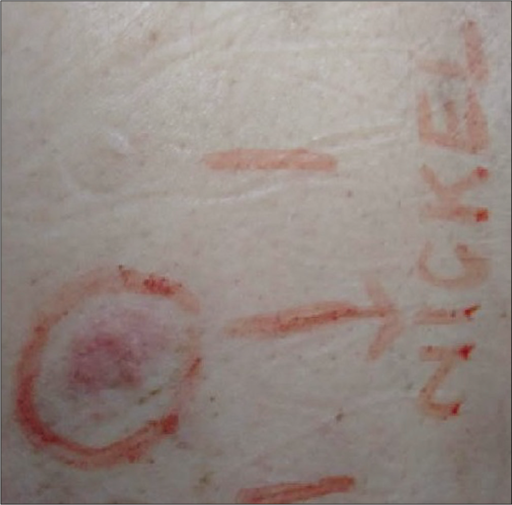 Postimplant positive reaction (1+) to nickel with erythema and infiltration at 96 hours. The patient tested negative to nickel in the preimplant test