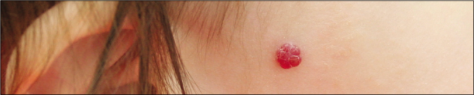 Pyogenic granuloma on the right cheek in a 1.5-year girl, before laser treatment