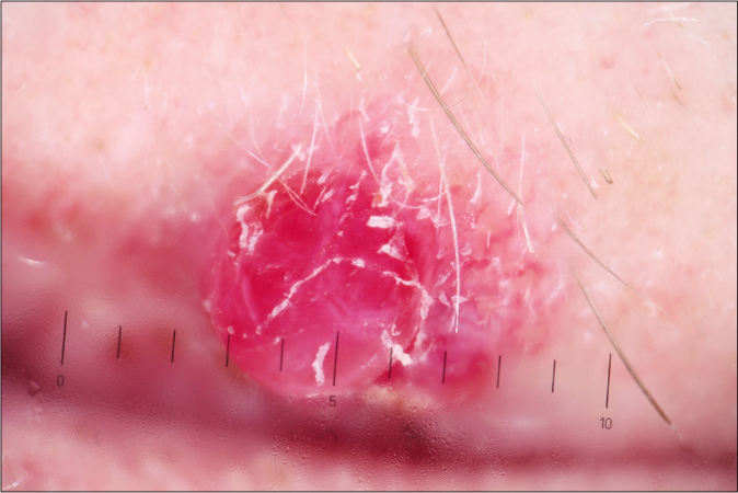 Dermoscopy of pyogenic granuloma: the focus is symmetrical, the boundaries are clear cut and the structure is homogeneous, lacunar, well-defined, rounded or oval red structures present