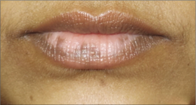 Patient 1 with lip vitiligo