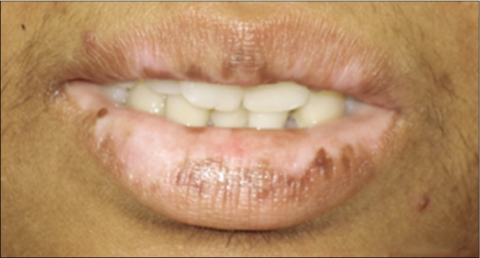 Patient 2 with lip vitiligo