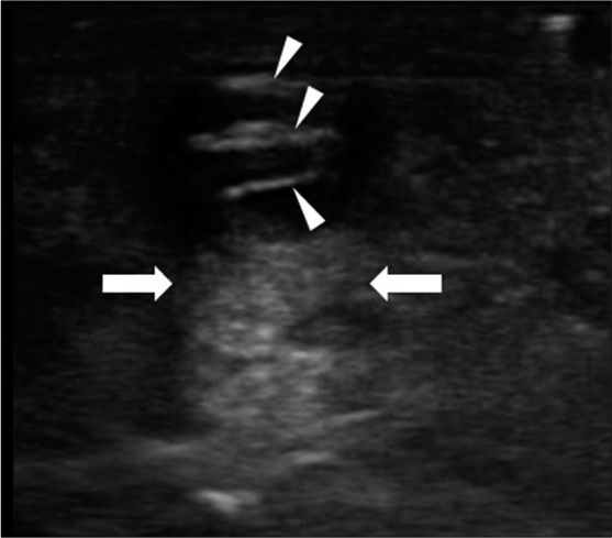 Ultrasound image showing a well-circumscribed hypoechoic mass. Posterior acoustic enhancement (arrows) and hyperechoic strips (arrowheads) are seen