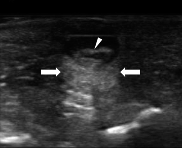 Ultrasound image showing a well-circumscribed hypoechoic masswith posterior acoustic enhancement (arrows) and hyperechoic strips (arrowheads)