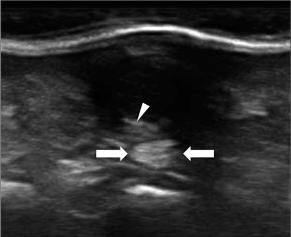 Ultrasound image showing a poorly circumscribed hypoechoic mass with posterior acoustic enhancement (arrows) and hyperechoic strips (arrowheads)