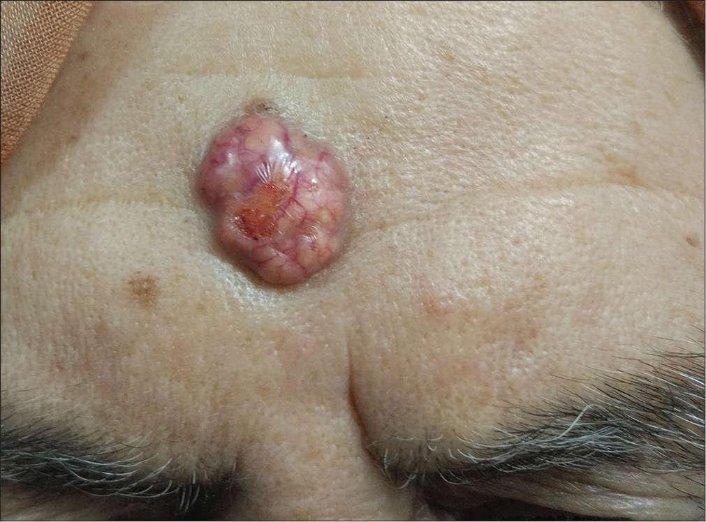 Yellow-pink colored, vascularized firm nodule on the forehead with a central ulcer in the size of 3.1 cm × 2.8 cm