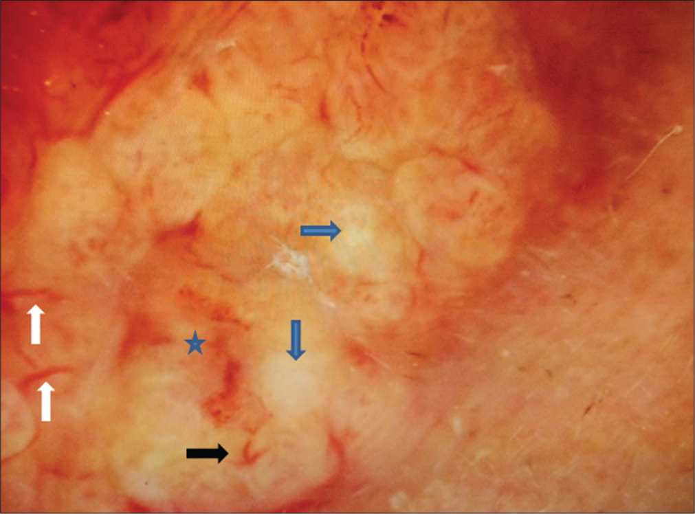 White arrows show linear vessels, black arrow shows hairpin vessel, blue arrows show white-yellow structures and asterisks shows the bleeding-ulcerated area in the centre on a yellowish background. MoleMax 3, nonpolarized computer-based video dermoscope, ×30 magnification