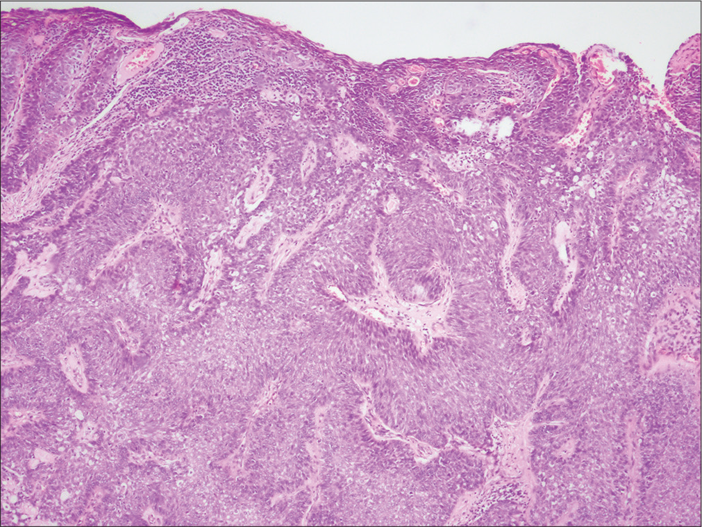 Tumor composed of clear cells between basaloid cells with epidermal ulceration (H and E, ×40)