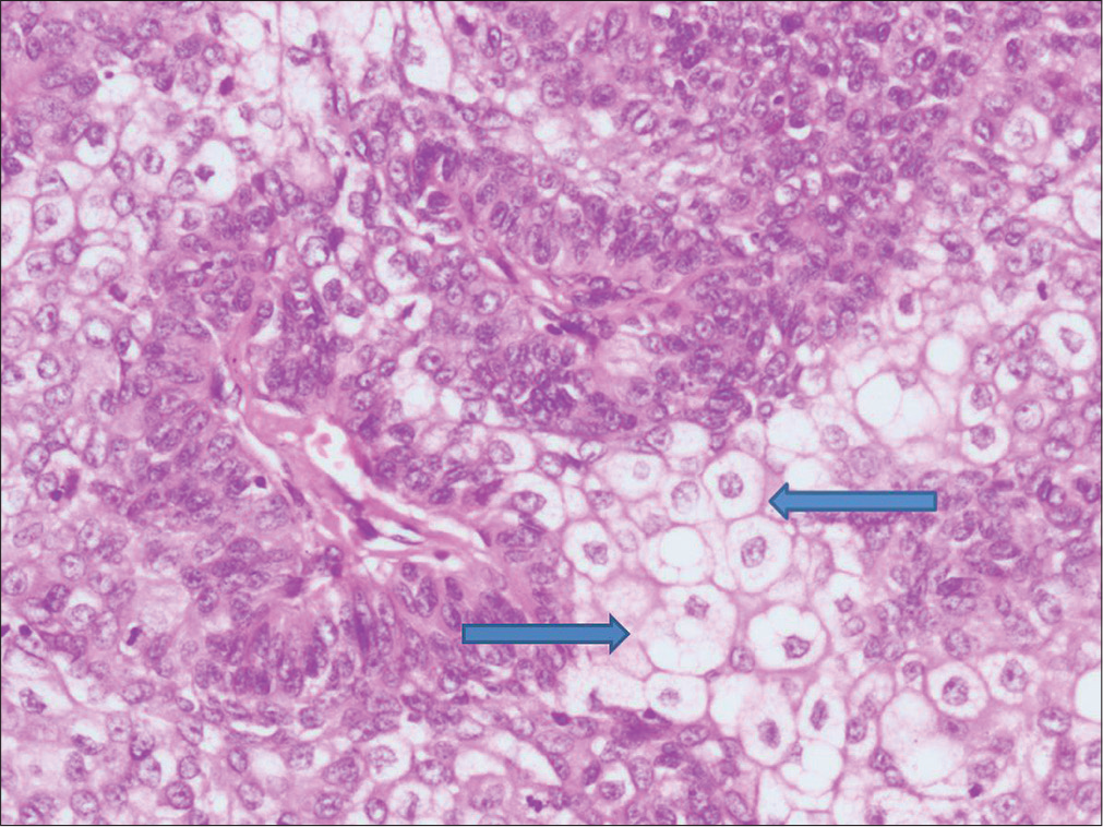 Sebaceous tumor cells with atypical basaloid cells (H and E, ×200) (arrows show tumor cells)