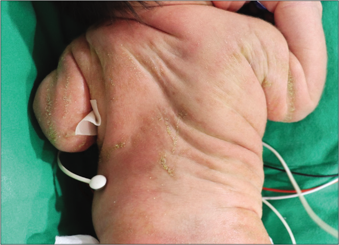 Distinctive cutaneous manifestations with orthopedic abnormalities. Yellow-to-white hyperkeratotic scales on the back distributed along Blaschko lines