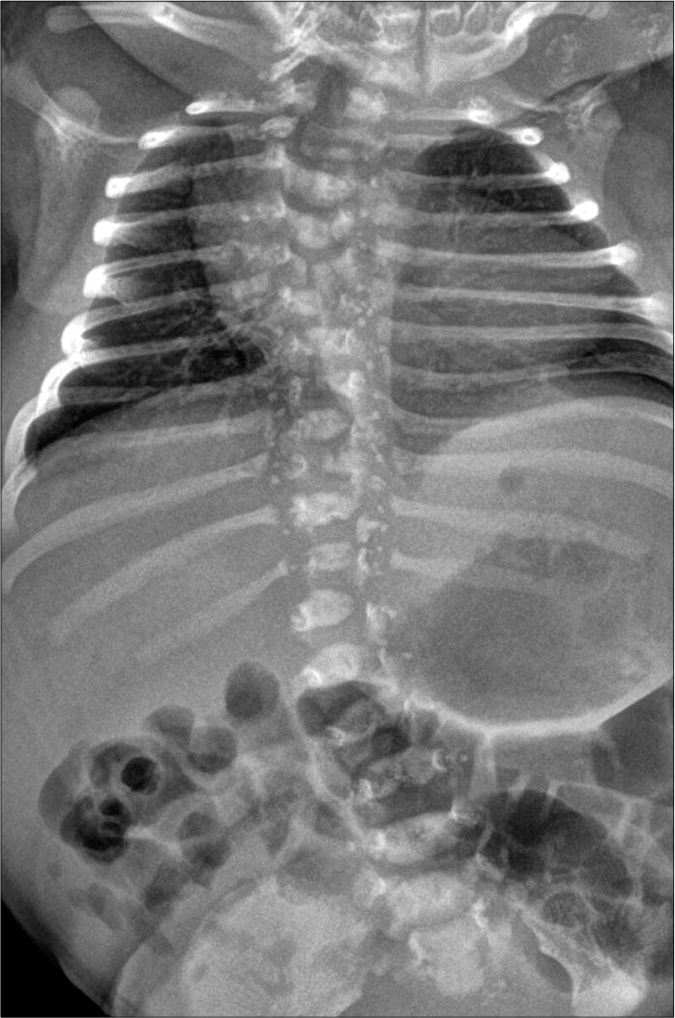 Radiologic characteristics of the patient. Punctate stippled calcification in the vertebral bodies of multiple thoracolumbar vertebrae and sternum with scoliosis.