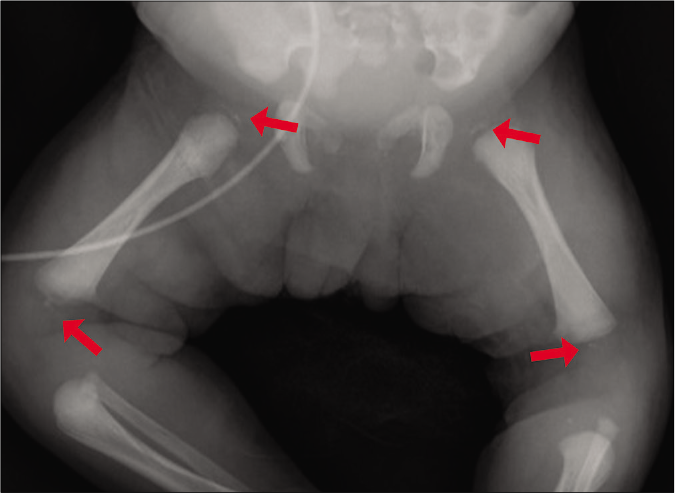 Punctate stippled calcifications also found in both the epiphysis of the femur (red arrows)